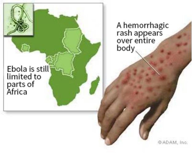 Ebola Virus - Most Dangerous Viruses in Human History