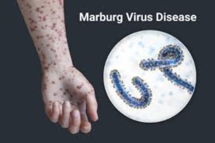 Marburg Virus - Most Dangerous Viruses in Human History